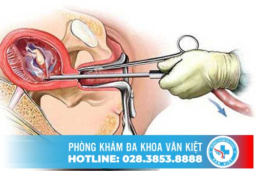 Những điều cần lưu ý khi phá thai theo tháng