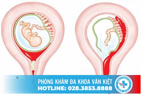 Phải làm gì khi có thai ngoài ý muốn? Phải làm gì khi có thai ngoài ý muốn?